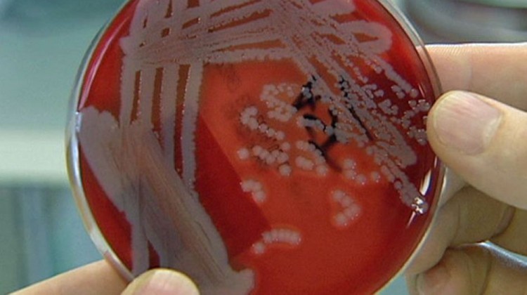 Melioidosis hinh anh 01